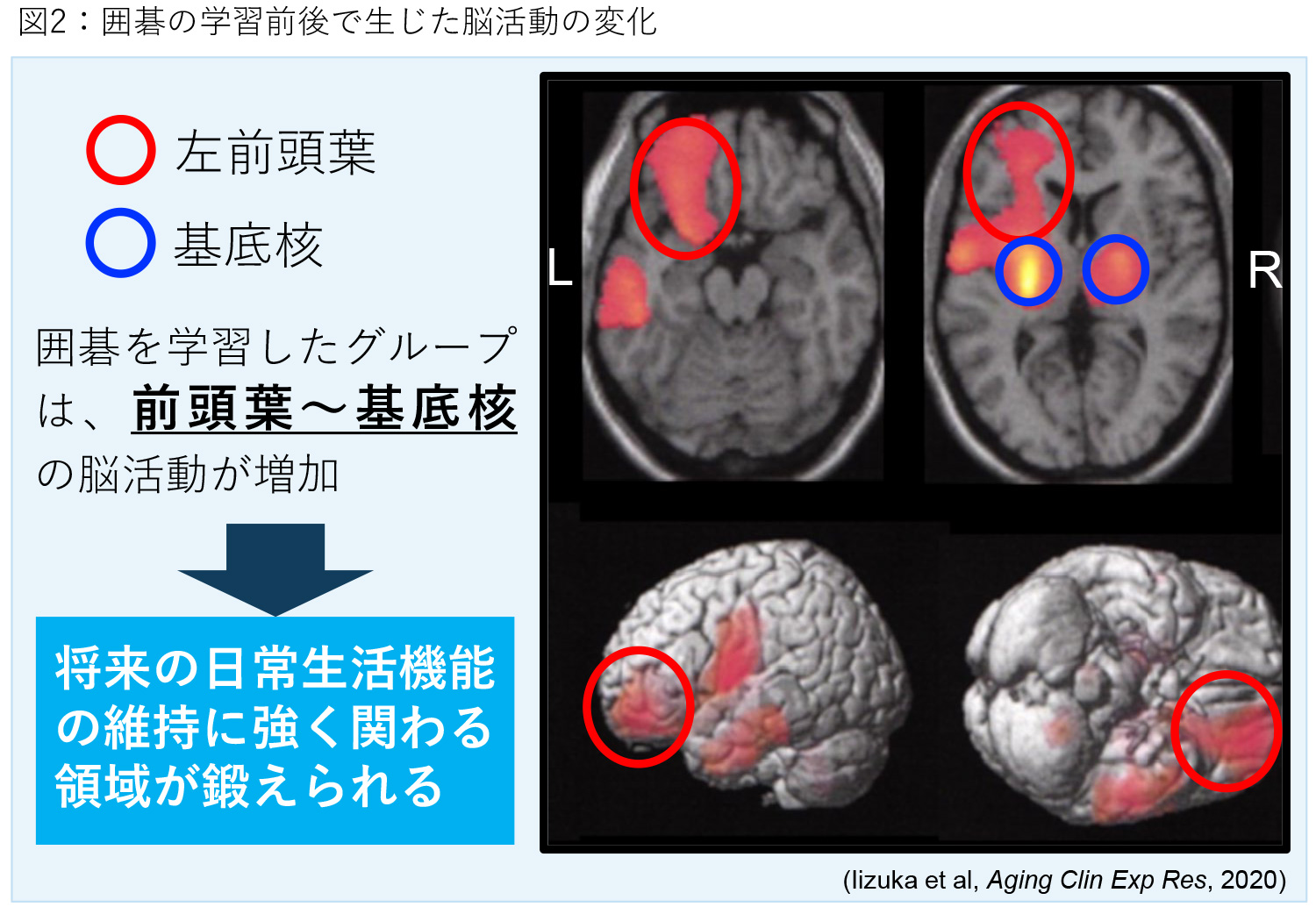 図2:囲碁の学習前後で生じた脳活動の変化